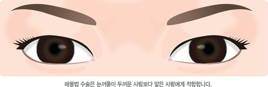 매몰법 수술은 눈꺼풀이 두꺼운 사람보다 얇은 사람에게 적합합니다.