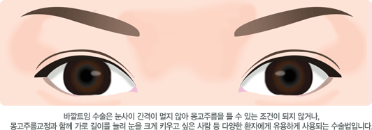 바깥트임 수술은 눈사이 간격이 멀지 않아 몽고주름을 틀 수 있는 조건이 되지 않거나, 몽고주름교정과 함께 가로 길이를 늘려 눈을 크게 키우고 싶은 사람 등 다양한 환자에게 유용하게 사용되는 수술법입니다.