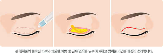 눈 윗꺼풀의 늘어진 피부와 과도한 지방 및 근육 조직을 일부 제거하고 쌍꺼풀 라인을 깨끗이 정리합니다.