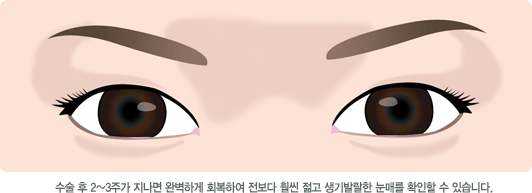 수술 후 2~3주가 지나면 완벽하게 회복하여 전보다 훨씬 젊고 생기발랄한 눈매를 확인할 수 있습니다.
