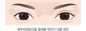 좌우비대칭으로 쌍꺼풀 위치가 다른 경우