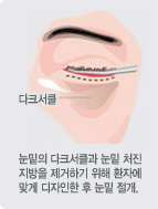 눈밑의 다크서클과 눈밑 처진 지방을 제거하기 위해 환자에 맞게 디자인한 후 눈밑 절개.