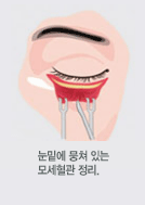 눈밑에 뭉쳐 있는모세혈관 정리.