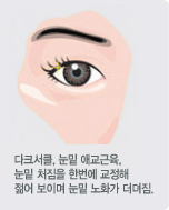 다크서클, 눈밑 애교근육, 눈밑 처짐을 한번에 교정해 젊어 보이며 눈밑 노화가 더뎌짐.