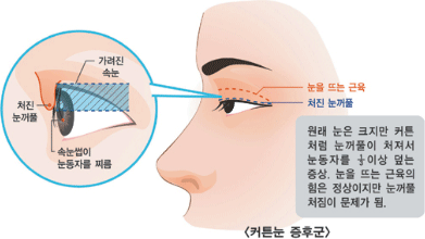 커튼눈 증후군