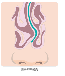 비중격만곡증