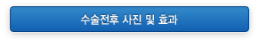 수술전후 사진 및 효과