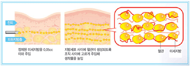 진피,피하지방층 정제된 미세지방을 0.05cc이하의 최소량으로 주입 지방세포 사이에 혈관이 생성되도록 최소량을 조직 사이에 고르게 주입해 생착률을 높임 