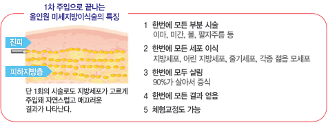 1차 주입으로 끝나는 올인원 미세지방이식술의 특징 , 1.한꺼번에 모든부분시술, 2.한꺼번에 모든 세포 이식 , 3.한 번에 모두 살림 , 4.한번에 모든 결과 얻음  , 5.체형교정도 가능