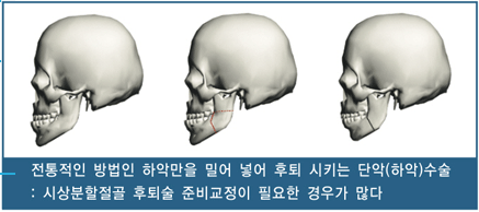 전통적인 방법인 하악만을 밀어 넣어 후퇴시키는 단악(하악)수술 : 시상분할절굴 후퇴술준비교정이 필요한 경우가 많다.