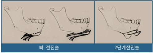 좌-뼈 전진술 이미지,우-2단계 전진술 이미지